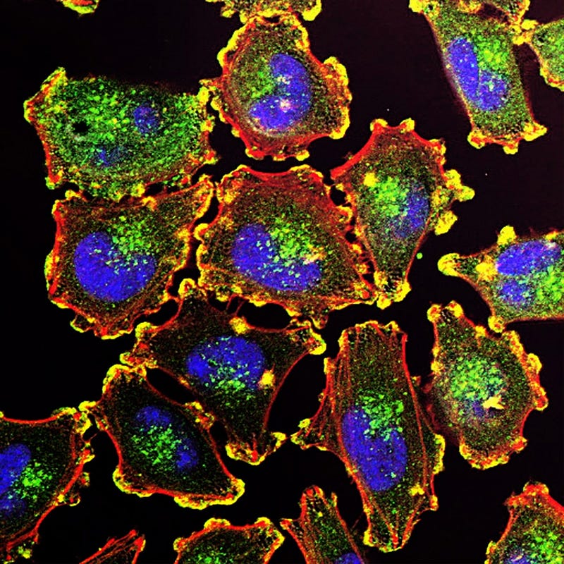 Metastatic melanoma cells in research