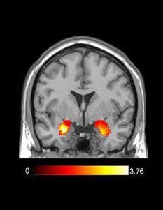 fMRI scan showing amygdala activation